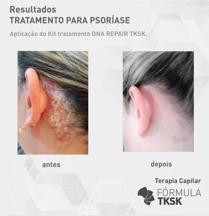 PSORIASEw-(1)